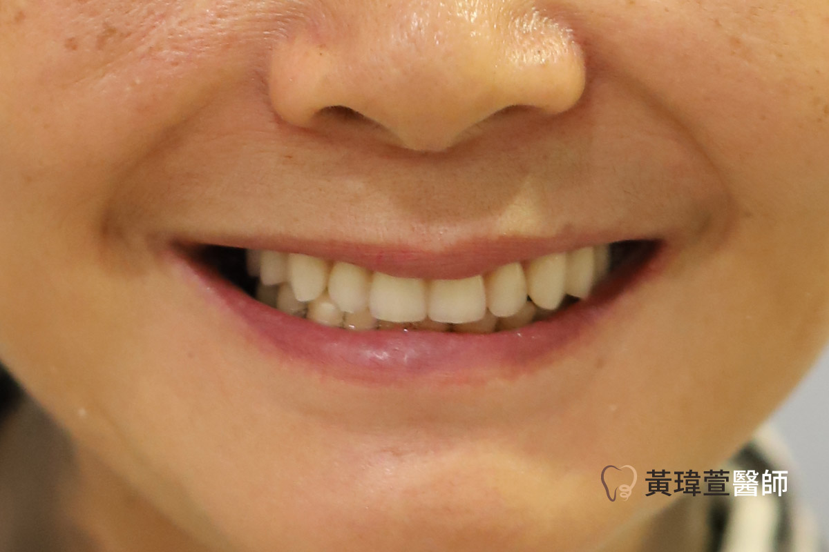 Read more about the article All-on-4全口重建案例-林女士