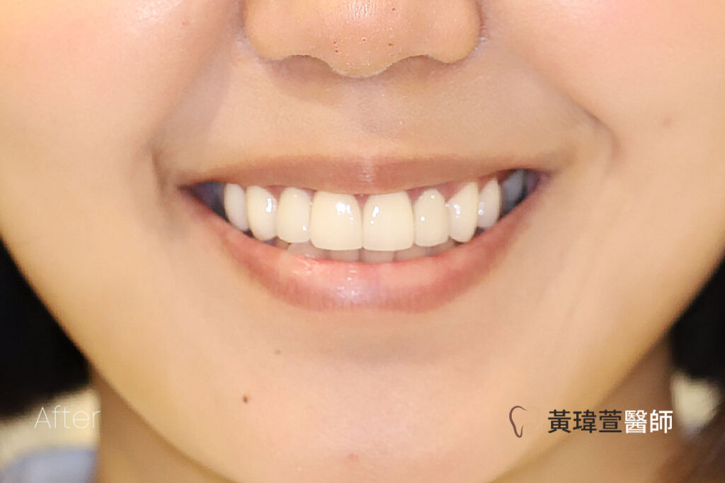 veneer case1 a1 1