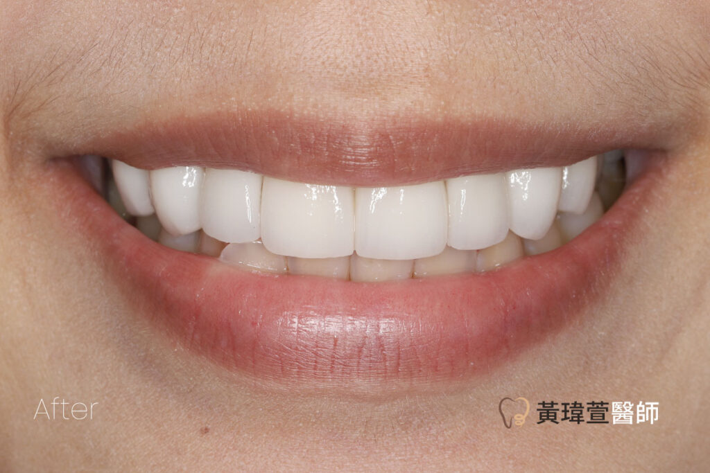 veneer case1 a2 1