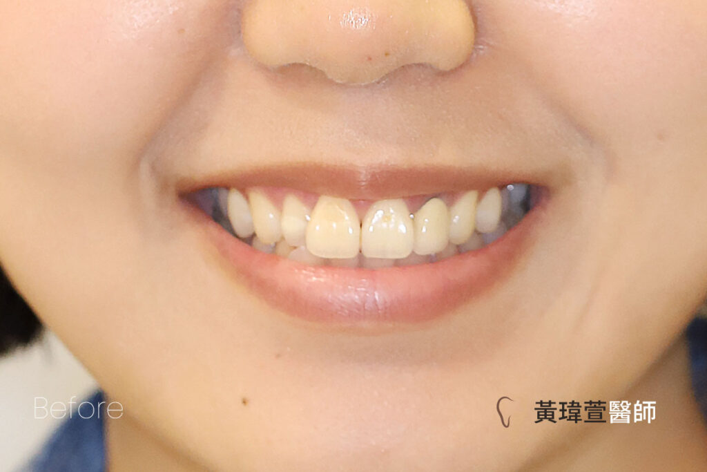 veneer case1 b1 1