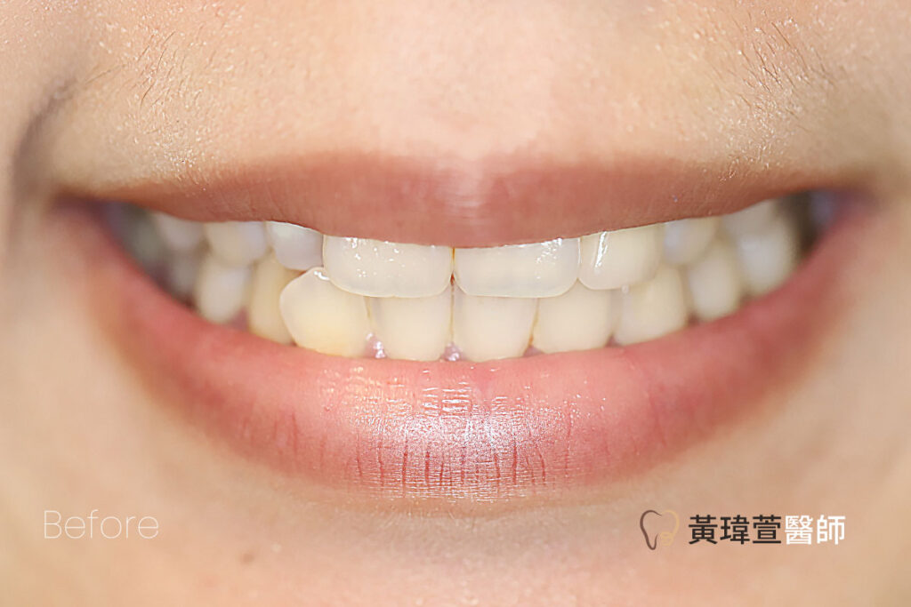 veneer case1 b2 1