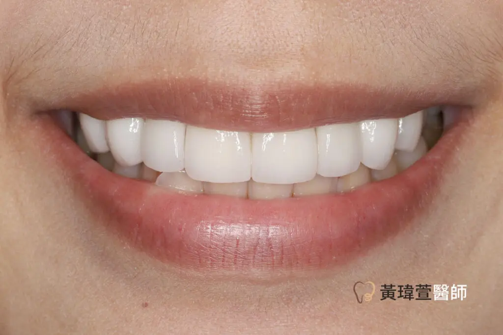 veneer case1 small 1