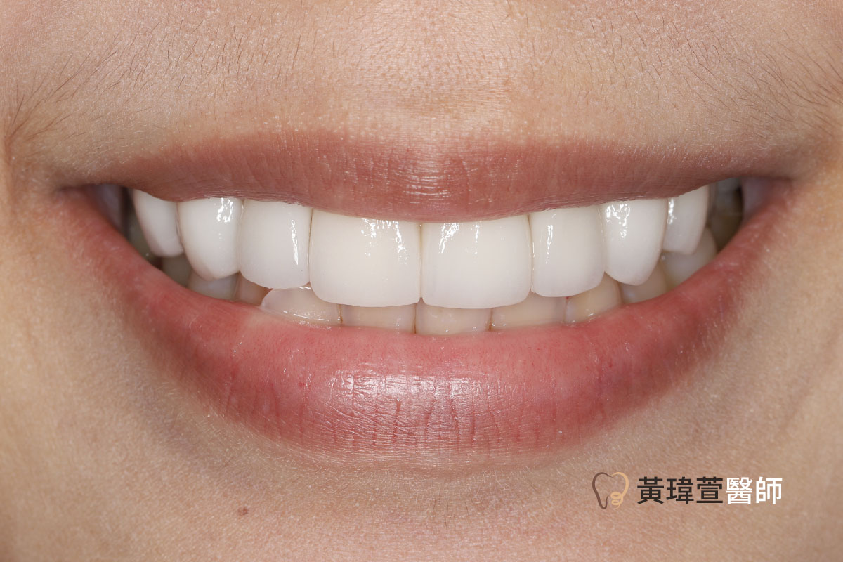 Read more about the article 陶瓷貼片案例-謝小姐