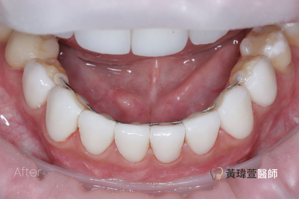 veneer case3 a3 1