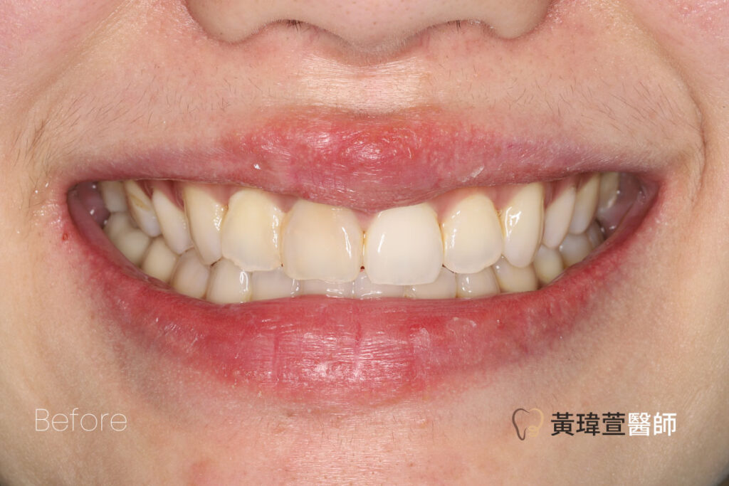 veneer case3 b1 1