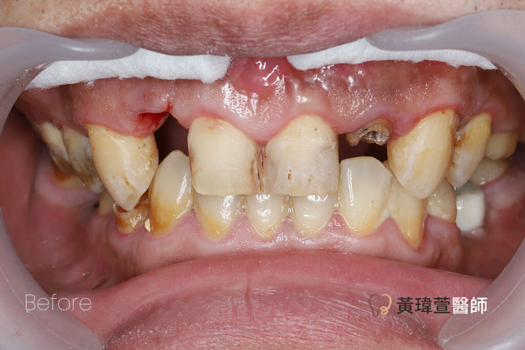 veneer case4 b1 1