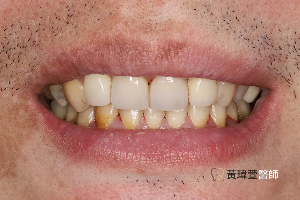 veneer case4 small 1