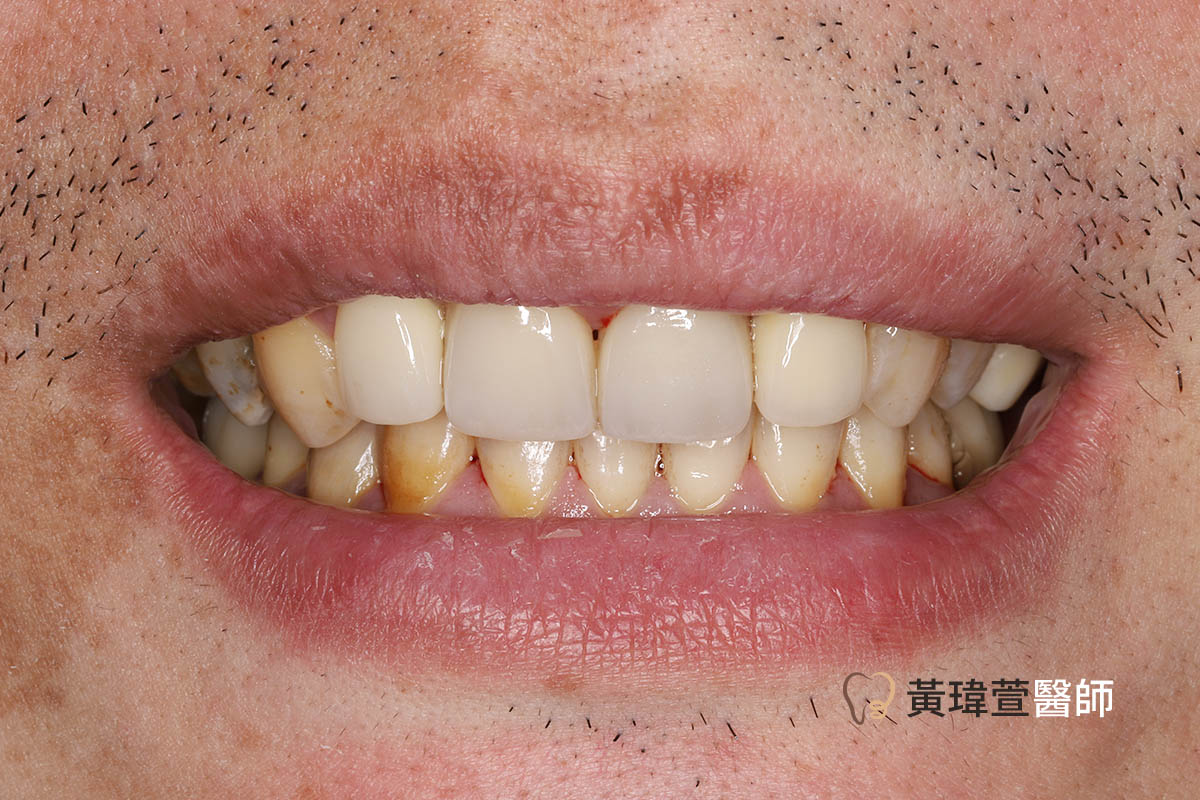 Read more about the article 陶瓷貼片+全瓷冠案例-黃先生