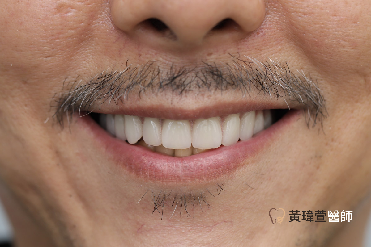 Read more about the article All-on-4全口重建案例-邱先生