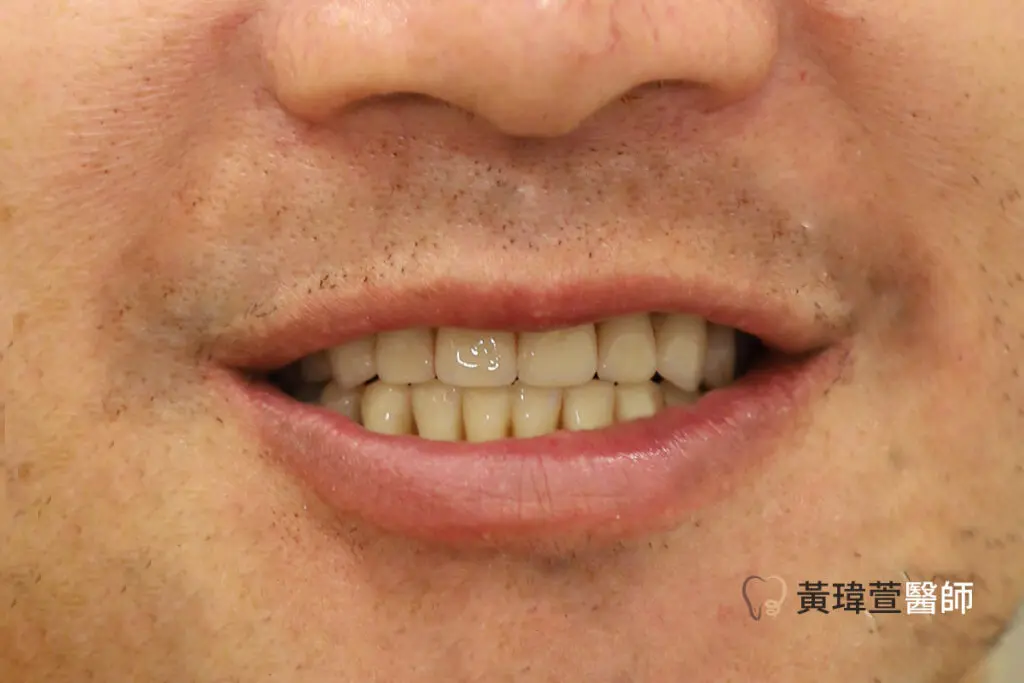 Read more about the article All-on-4全口重建案例-李先生